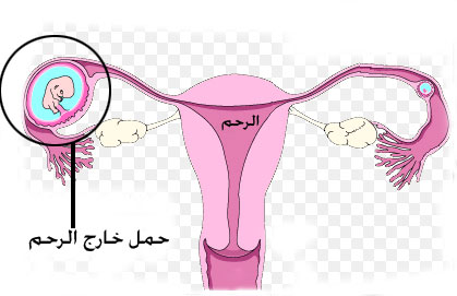 كيف يحدث الحمل خارج الرحم