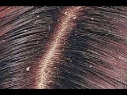 وصفات للقضاء علي قشرة الشعر