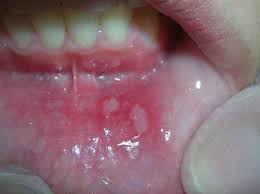 فطريات الفم وعلاجها بالاعشاب