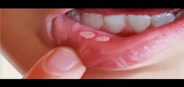 فطريات الفم وعلاجها بالأعشاب