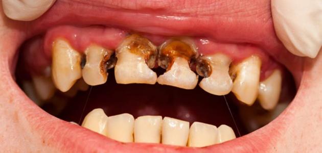كيف تعالج تسوس الاسنان بالاعشاب