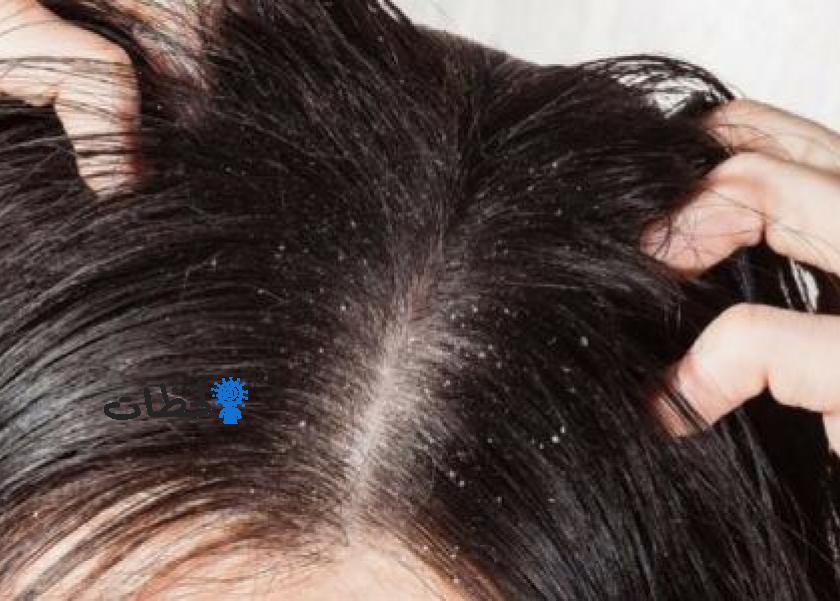 علاج القشرة للشعر – اقل الامكانيات تعالج قشرة الشعر